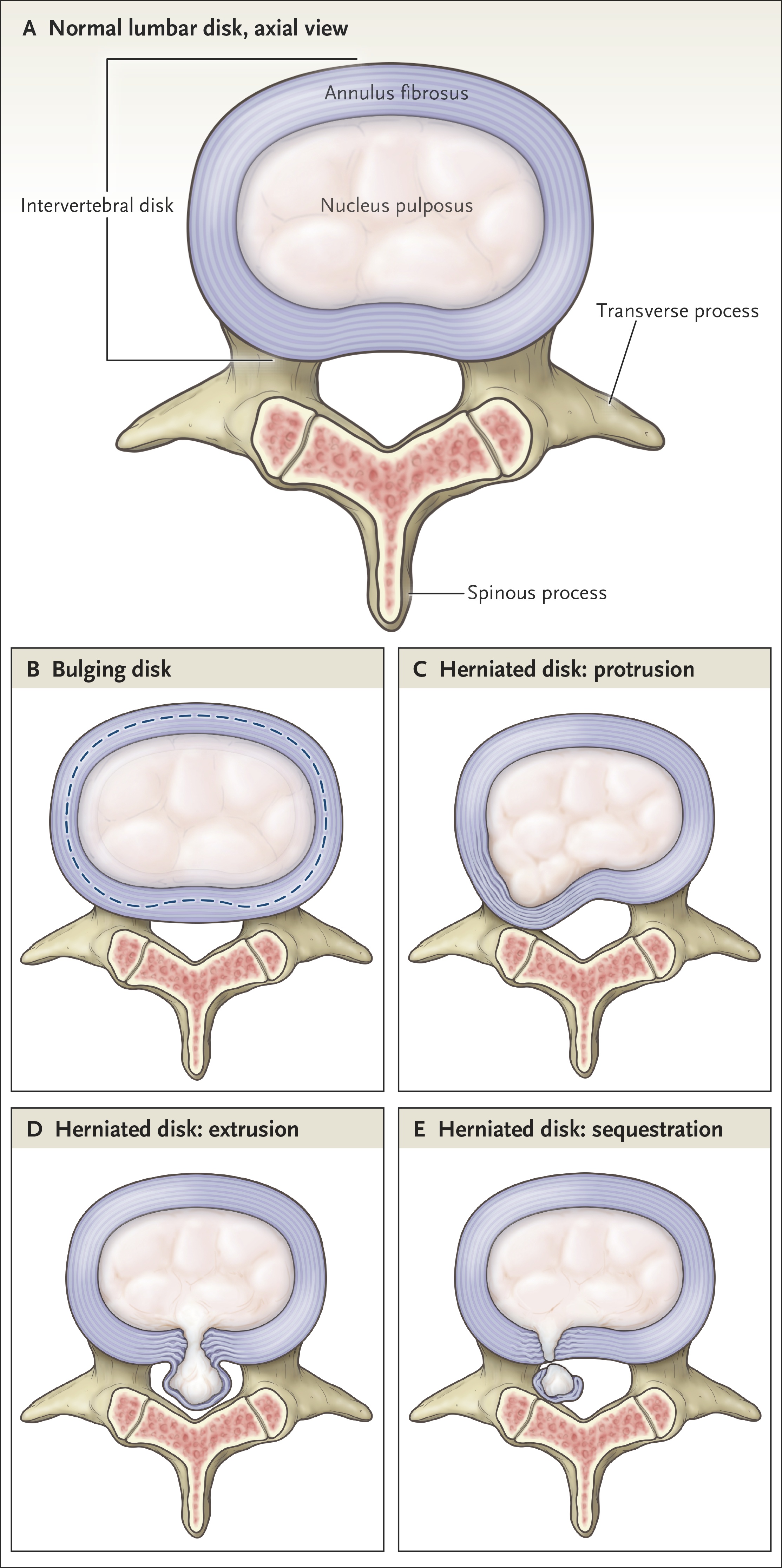 Standardized terminology for lumbar disc pathology from NEJM