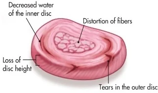 Nuclear material migrating into annular layers