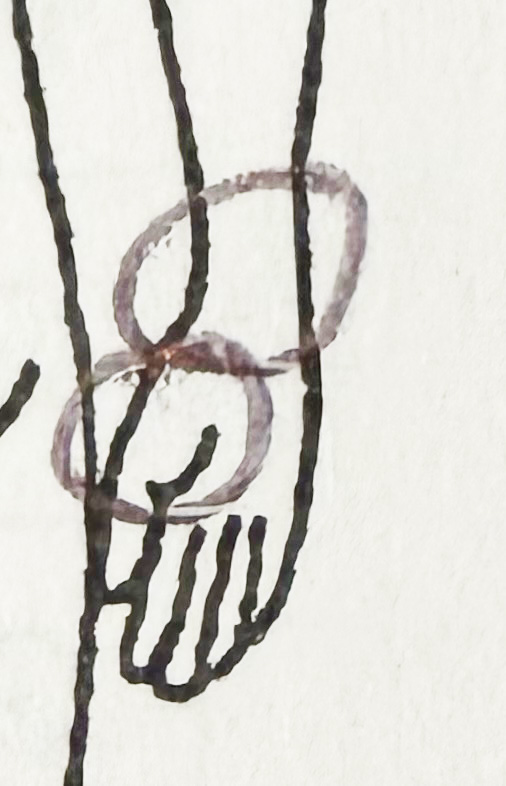 Initial pain drawing: radial thumb/thenar paresthesia