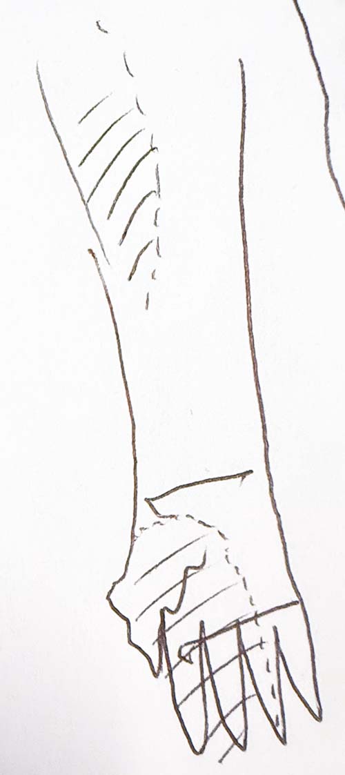 Interpreted final map: myofascial source