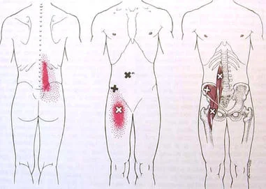 Psoas referral pain pattern