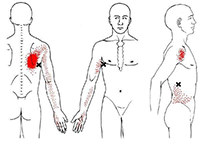 Latissimus dorsi referral pattern thumbnail