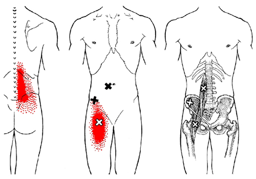 Psoas referral pattern thumbnail