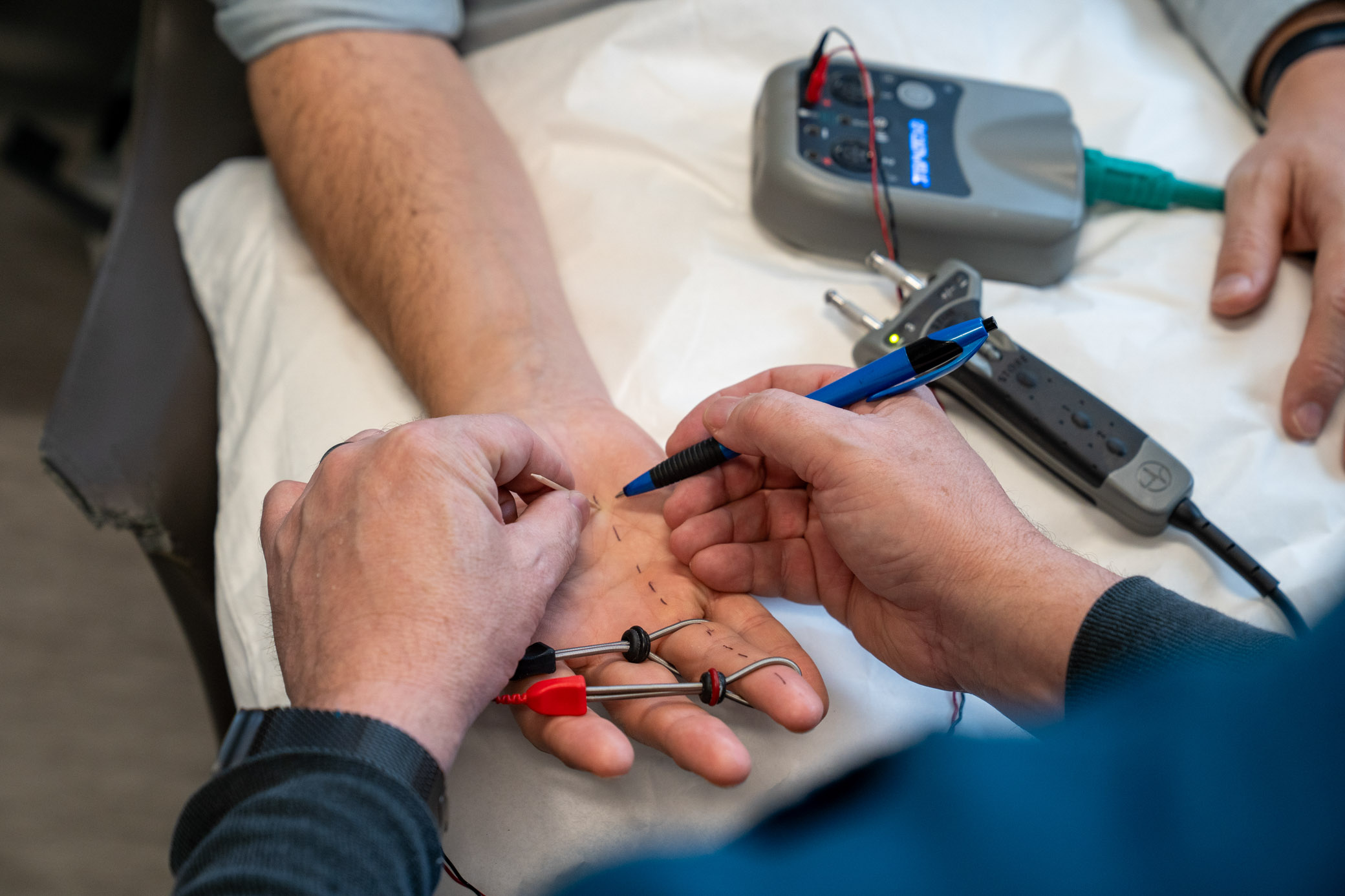 A nerve conduction study in progress: electrodes taped along the fingers, the palm marked in pen, the stimulator on the bed