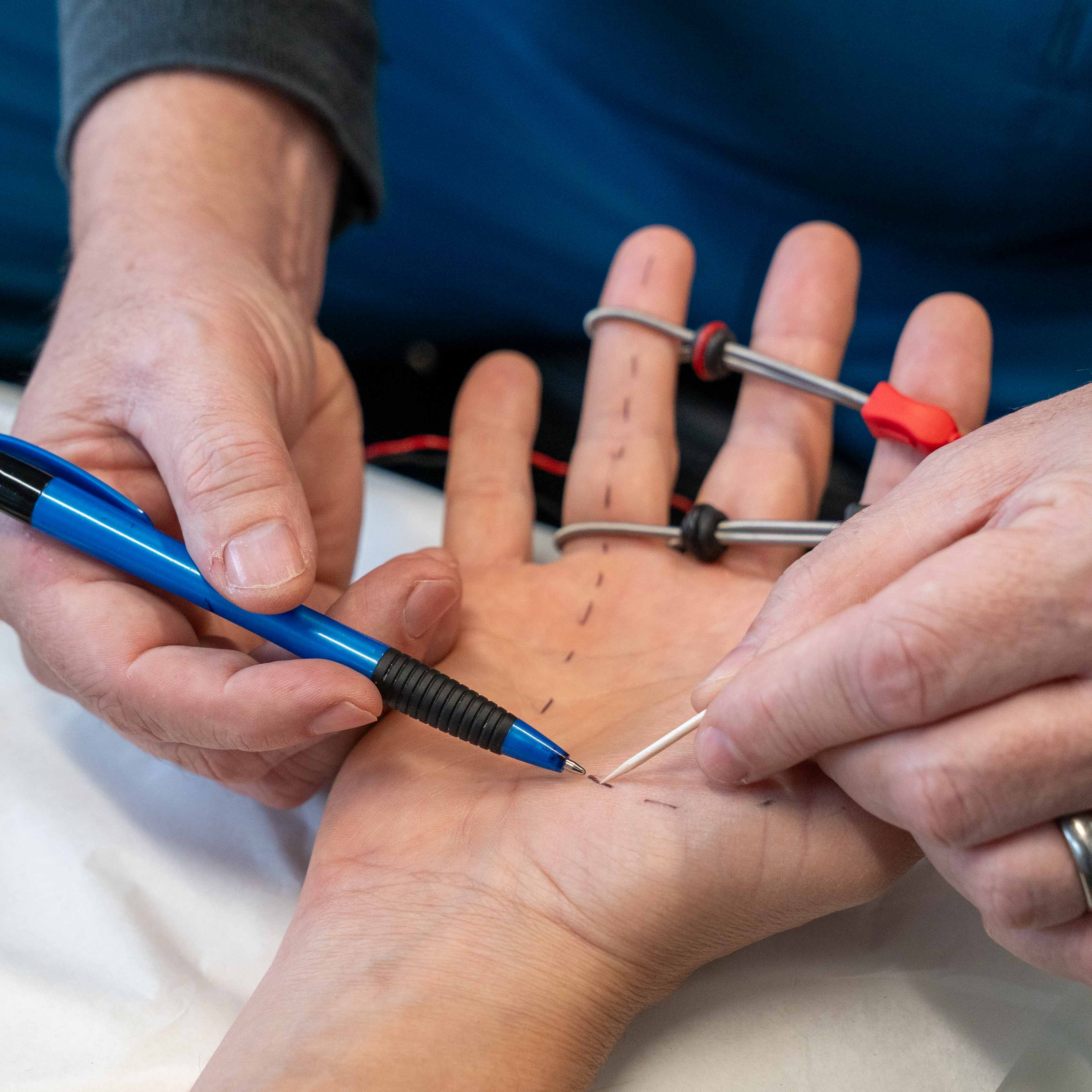 A nerve conduction study in progress